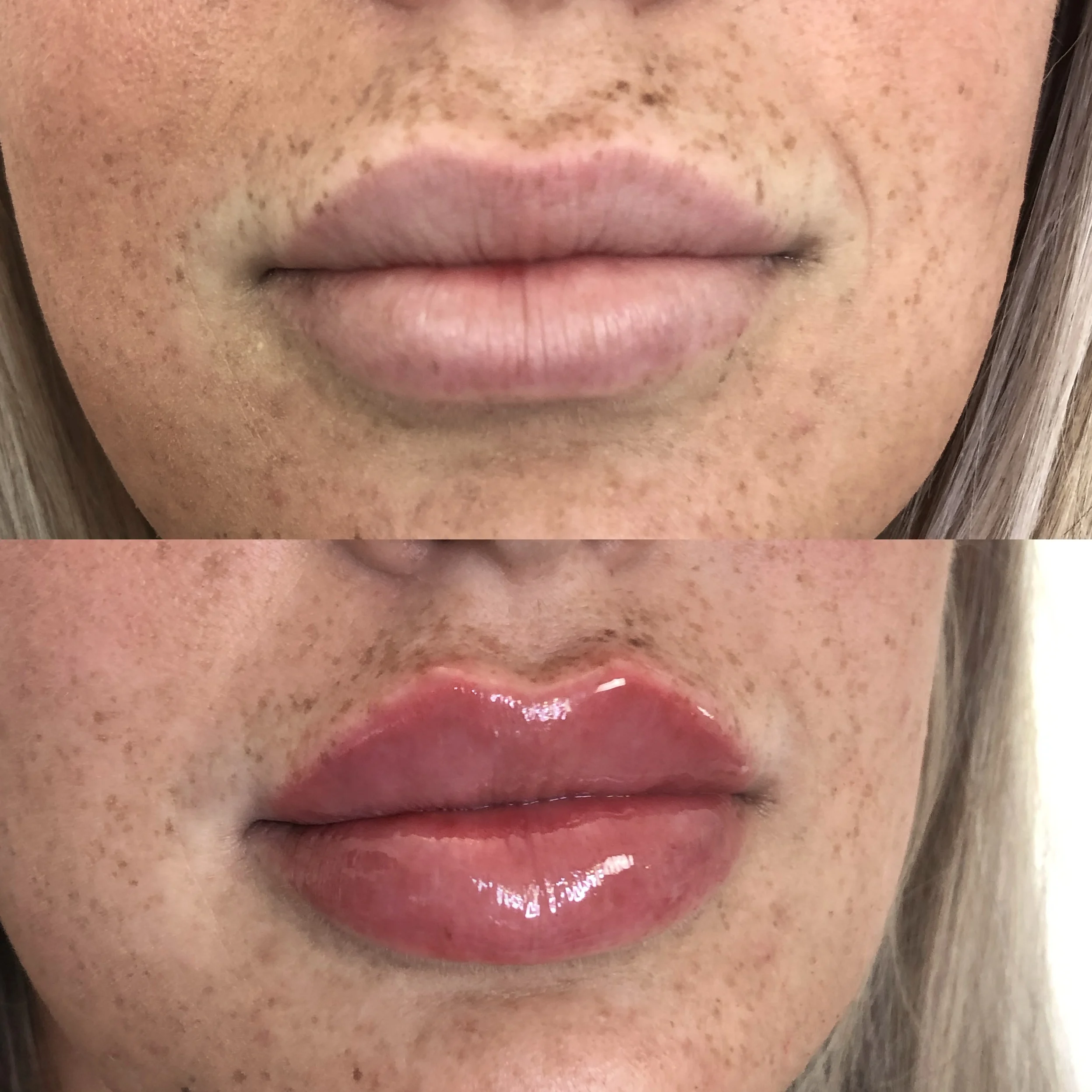 Lip fillers before and after