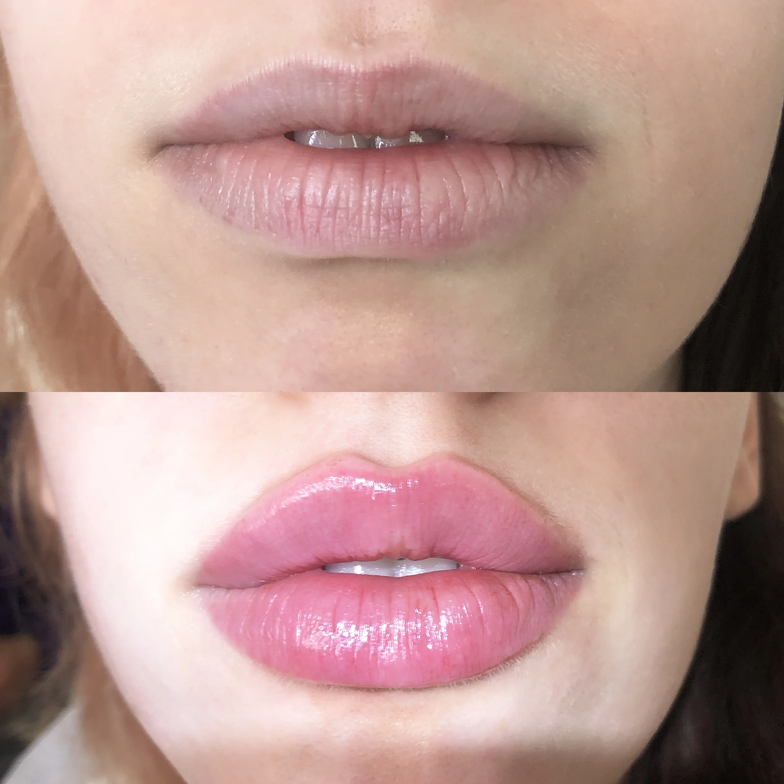 Lip augmentation before and after